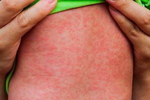 sarampo-e1744041505462